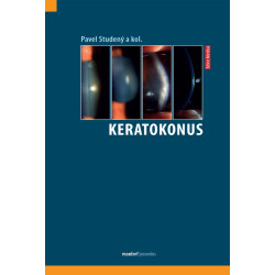 Keratokonus