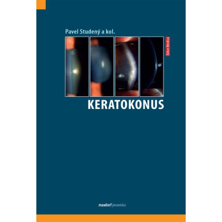 Keratokonus